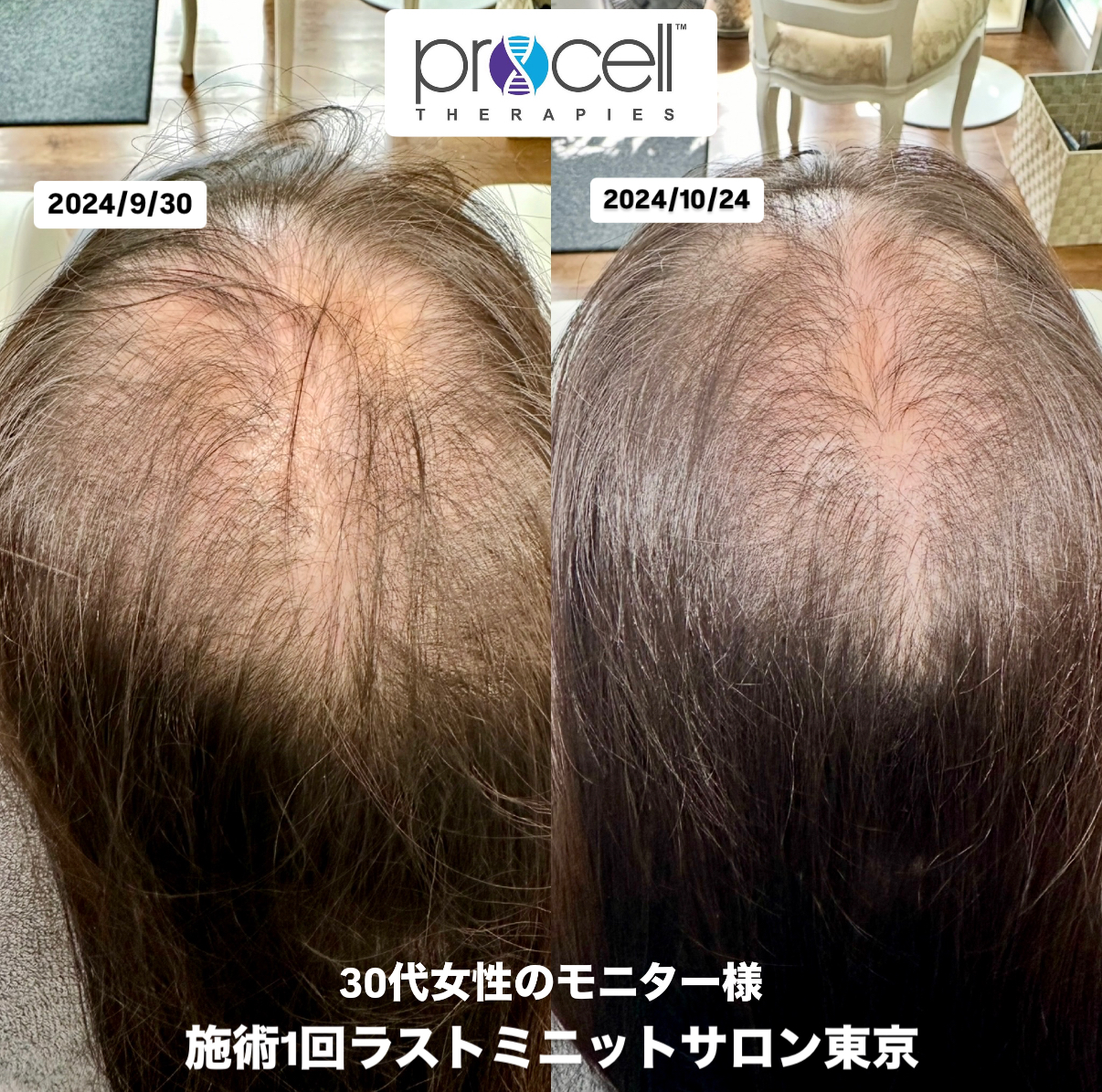 薄毛でもう悩まない！【プロセルセラピーズ】 | 東京・渋谷 プロセル