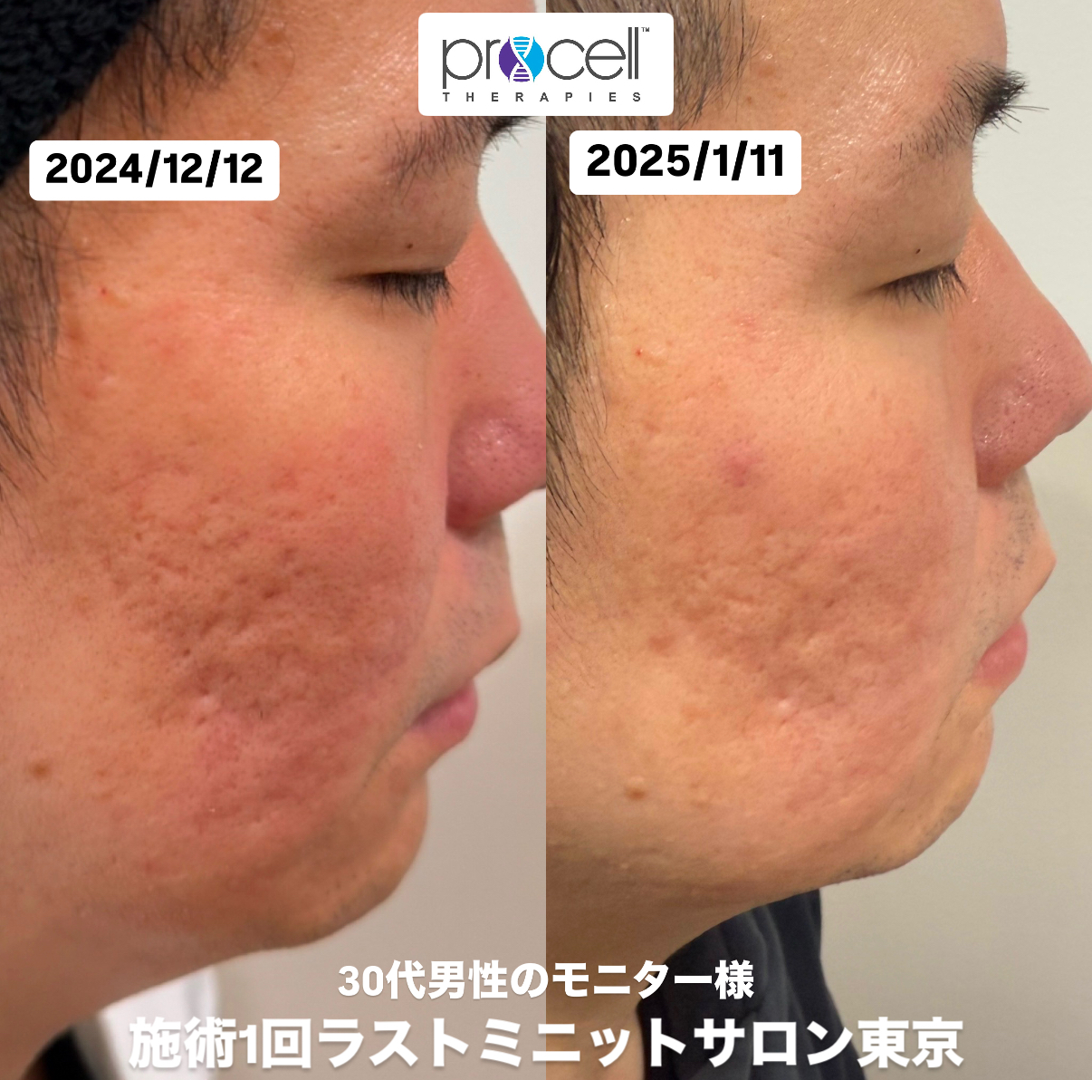 本気の肌質改善、プロセルセラピーズ！ | 東京・渋谷 プロセルセラピー
